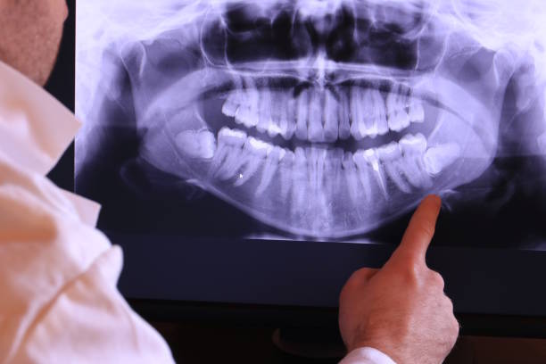 Best Emergency Wisdom Teeth Removal in Hoschton, GA